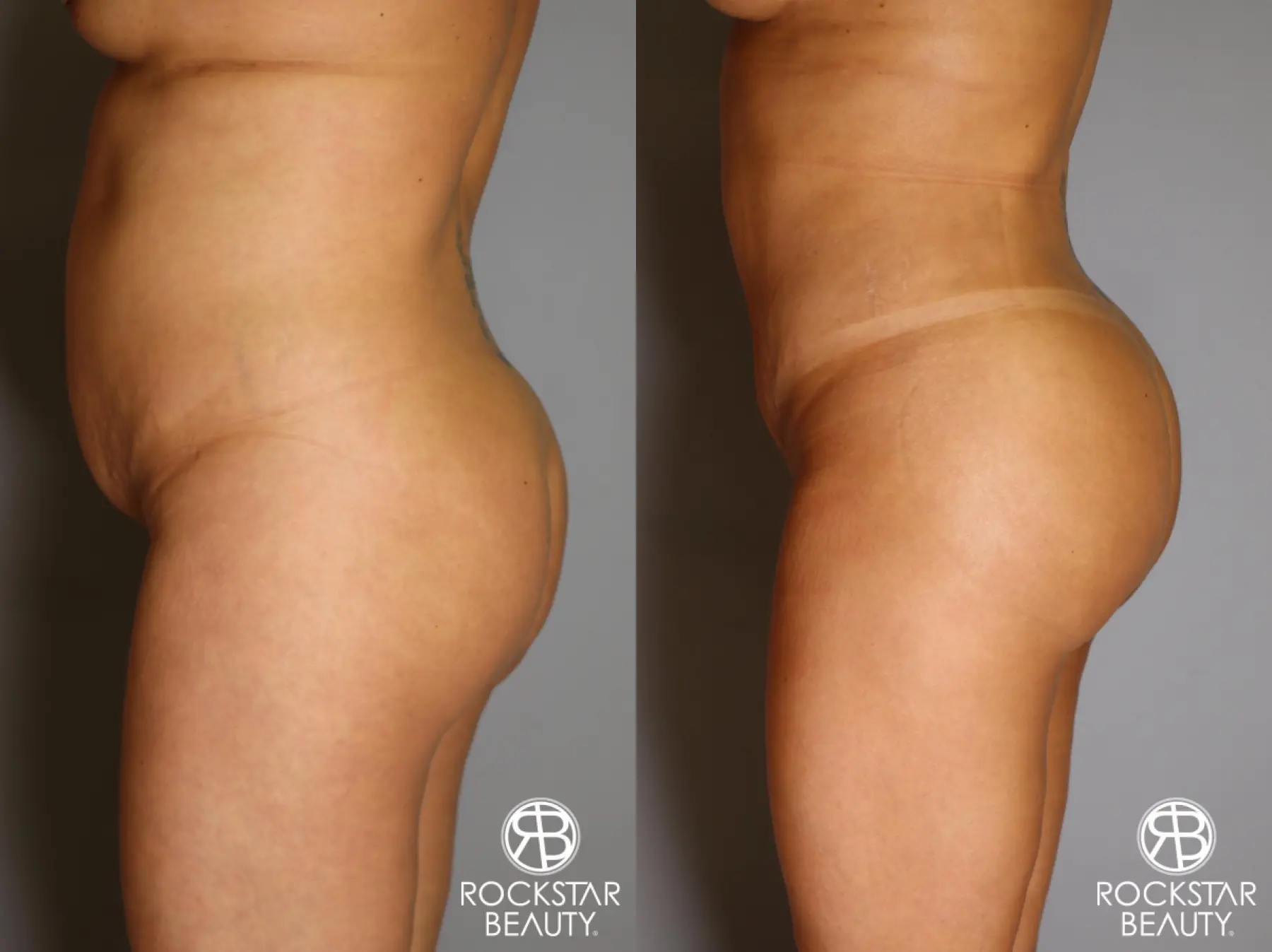 Brazilian Butt Lift: Patient 12 - Before and After 4