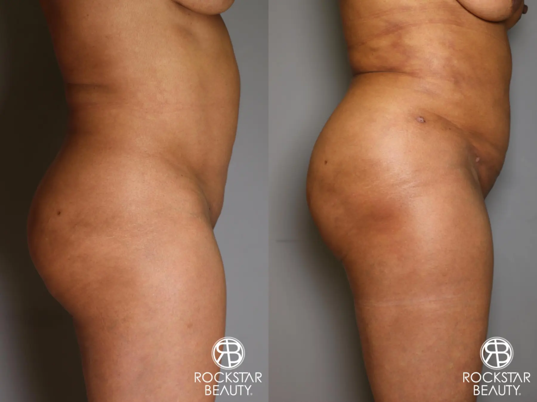 Brazilian Butt Lift: Patient 11 - Before and After 4