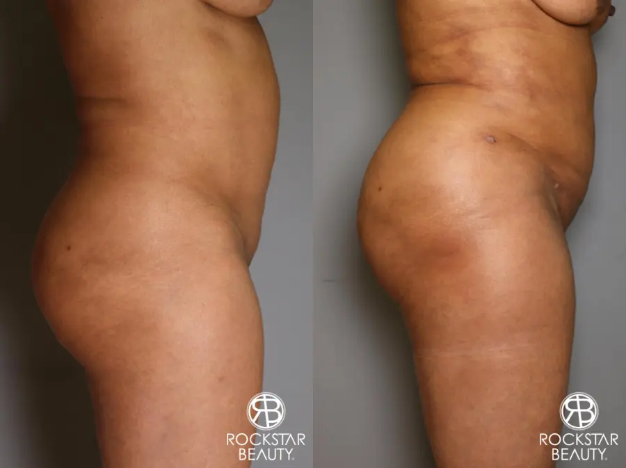Brazilian Butt Lift: Patient 11 - Before and After 4