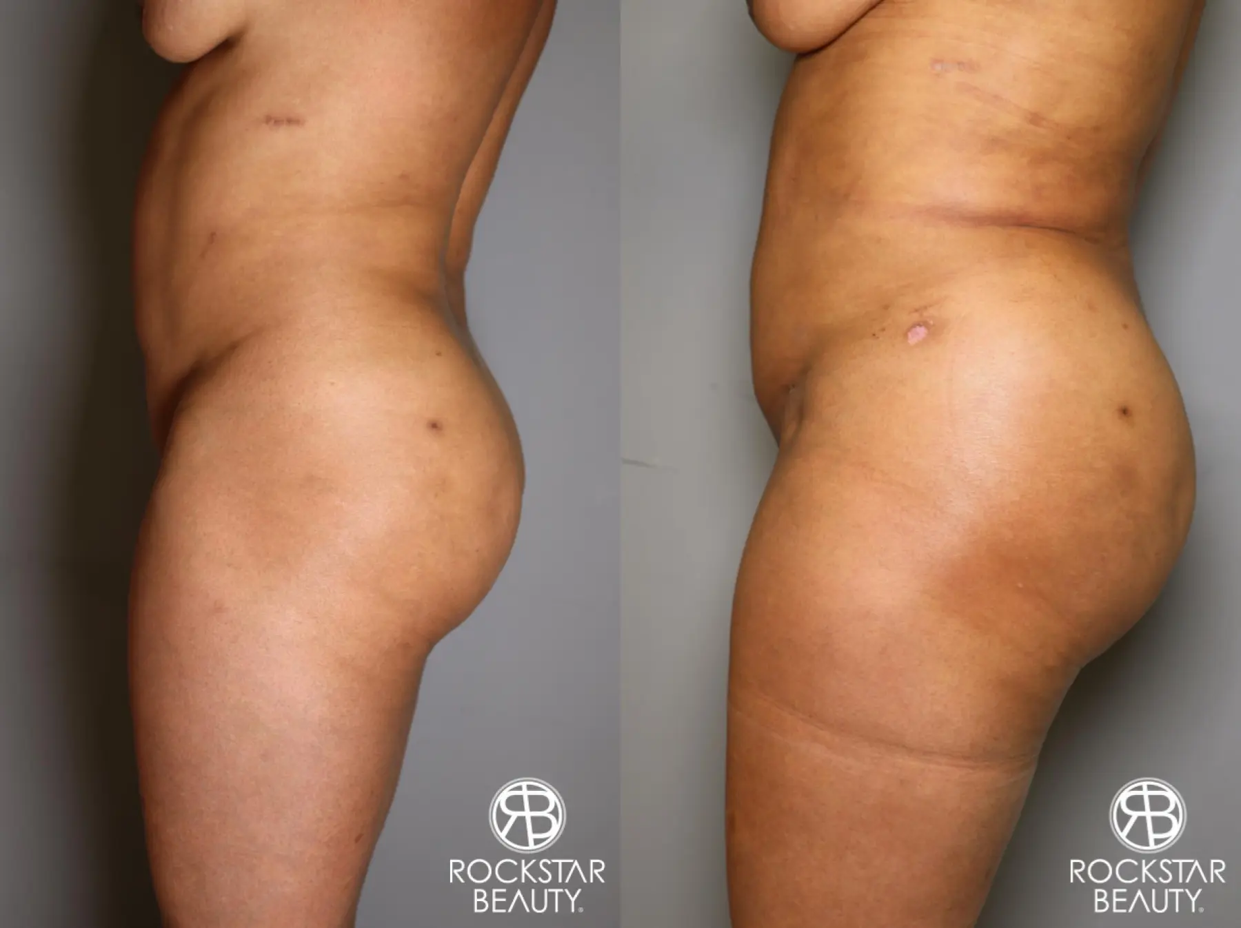 Brazilian Butt Lift: Patient 11 - Before and After 5
