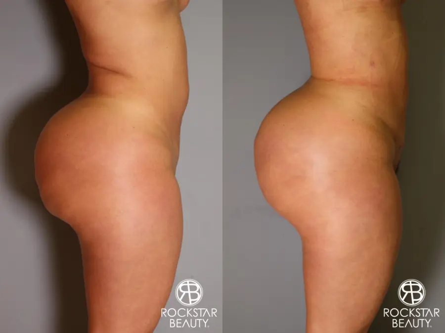 Brazilian Butt Lift: Patient 14 - Before and After 3