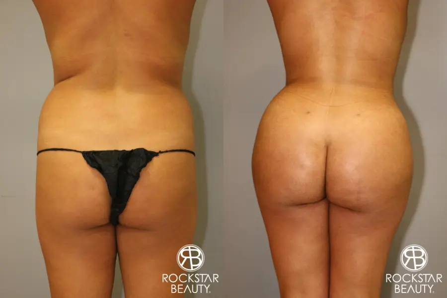 Brazilian Butt Lift: Patient 1 - Before and After  