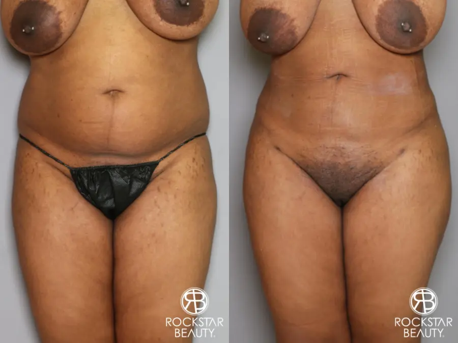 Brazilian Butt Lift: Patient 13 - Before and After 4