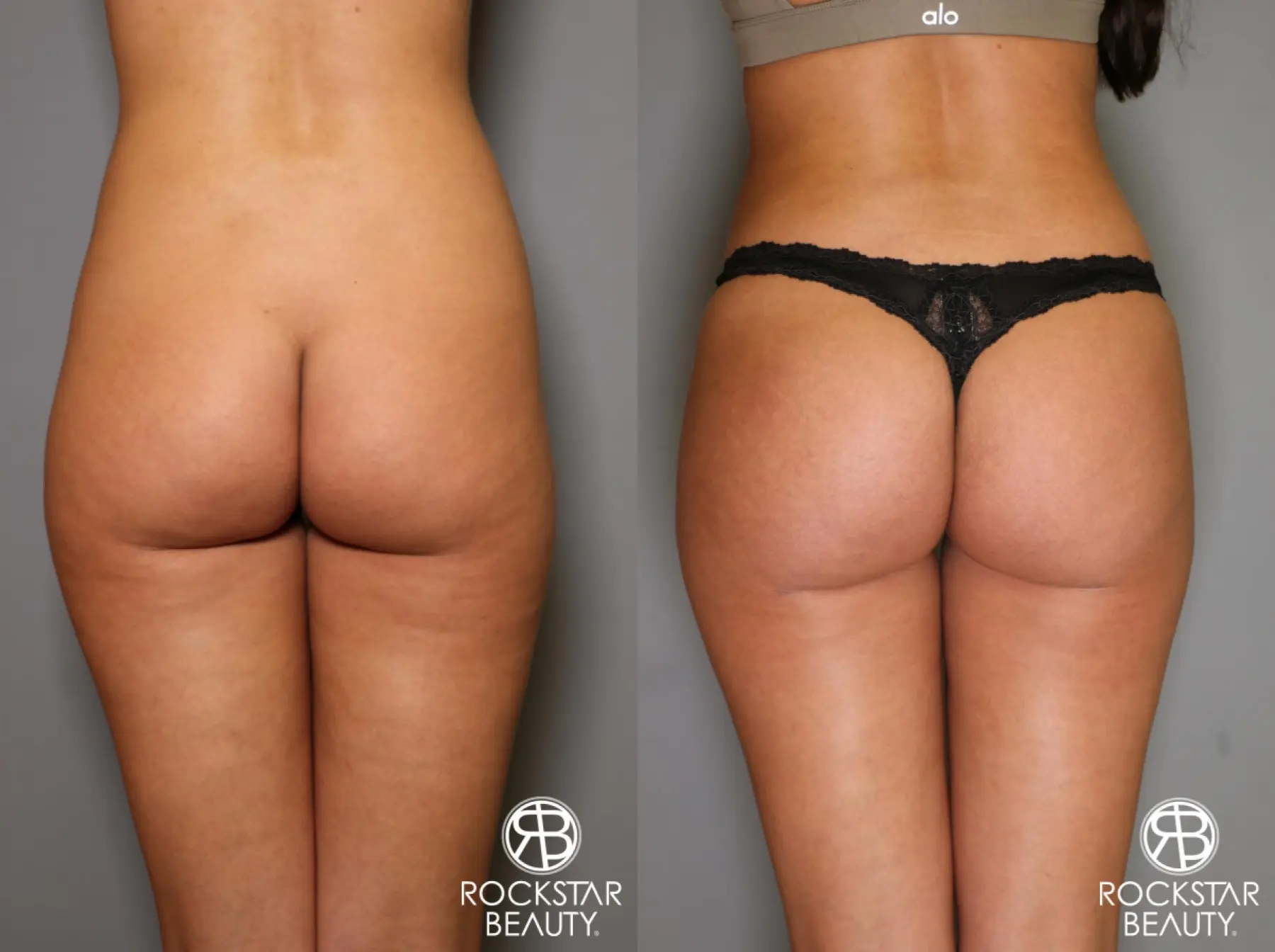 Brazilian Butt Lift: Patient 5 - Before and After  