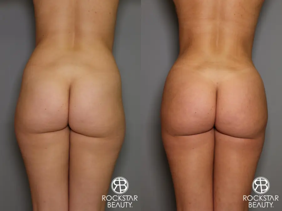 Brazilian Butt Lift: Patient 16 - Before and After 1