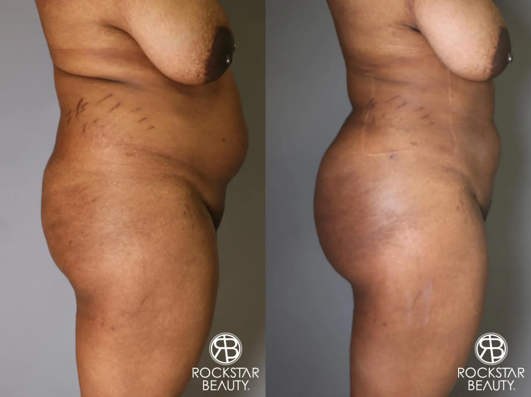 Brazilian Butt Lift: Patient 13 - Before and After 2