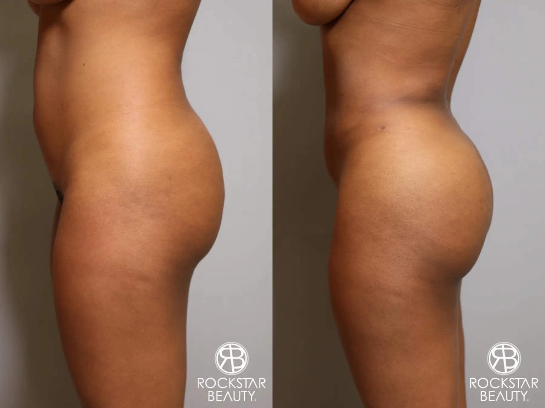 Brazilian Butt Lift: Patient 10 - Before and After 2