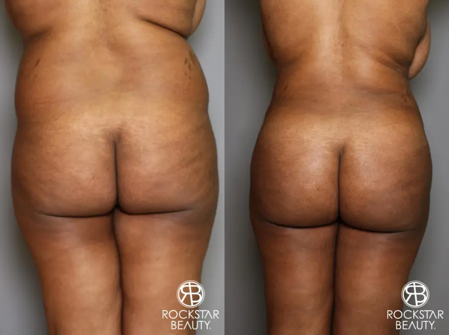 Brazilian Butt Lift: Patient 13 - Before and After 1