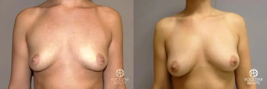 Breast Augmentation - Fat: Patient 1 - Before and After  