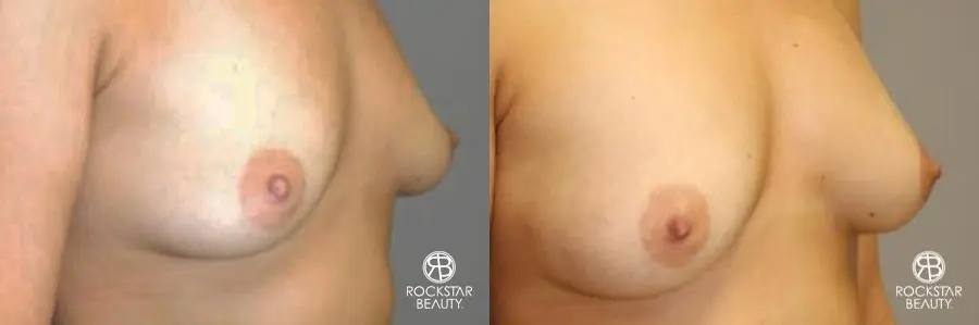 Breast Augmentation - Fat: Patient 1 - Before and After 2