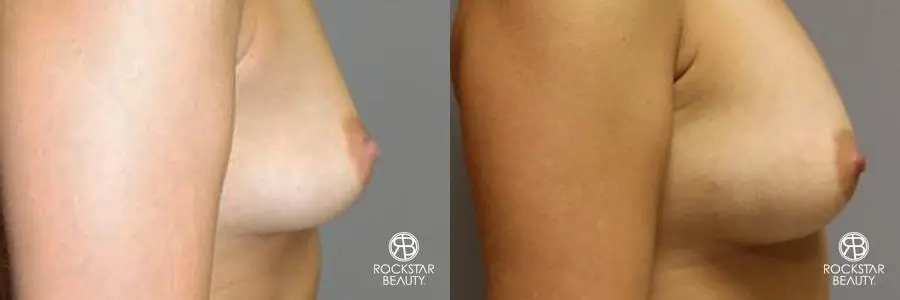 Breast Augmentation - Fat: Patient 1 - Before and After 3