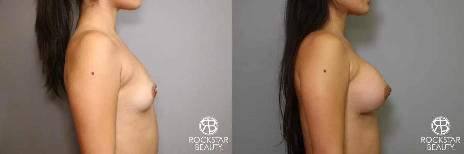 Breast Augmentation: Patient 4 - Before and After 3