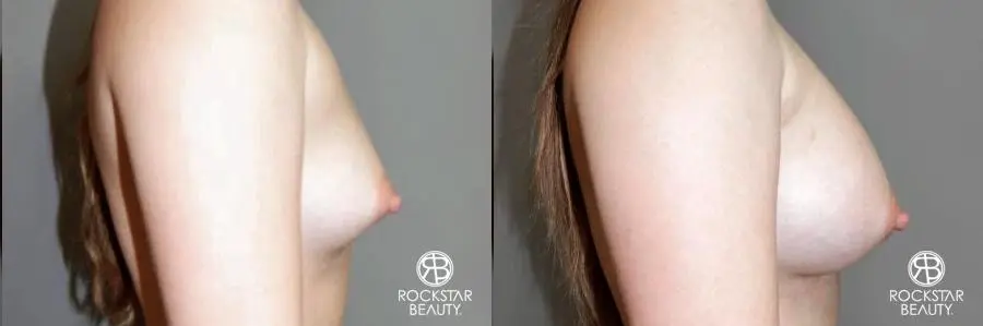 Breast Augmentation: Patient 6 - Before and After 3