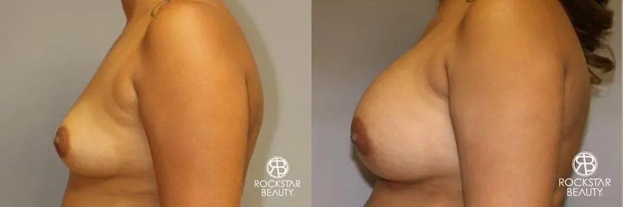 Breast Augmentation: Patient 9 - Before and After 4