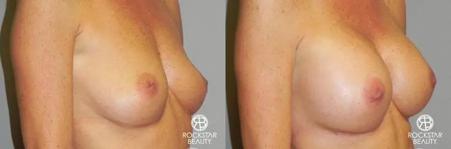 Breast Augmentation: Patient 5 - Before and After 2