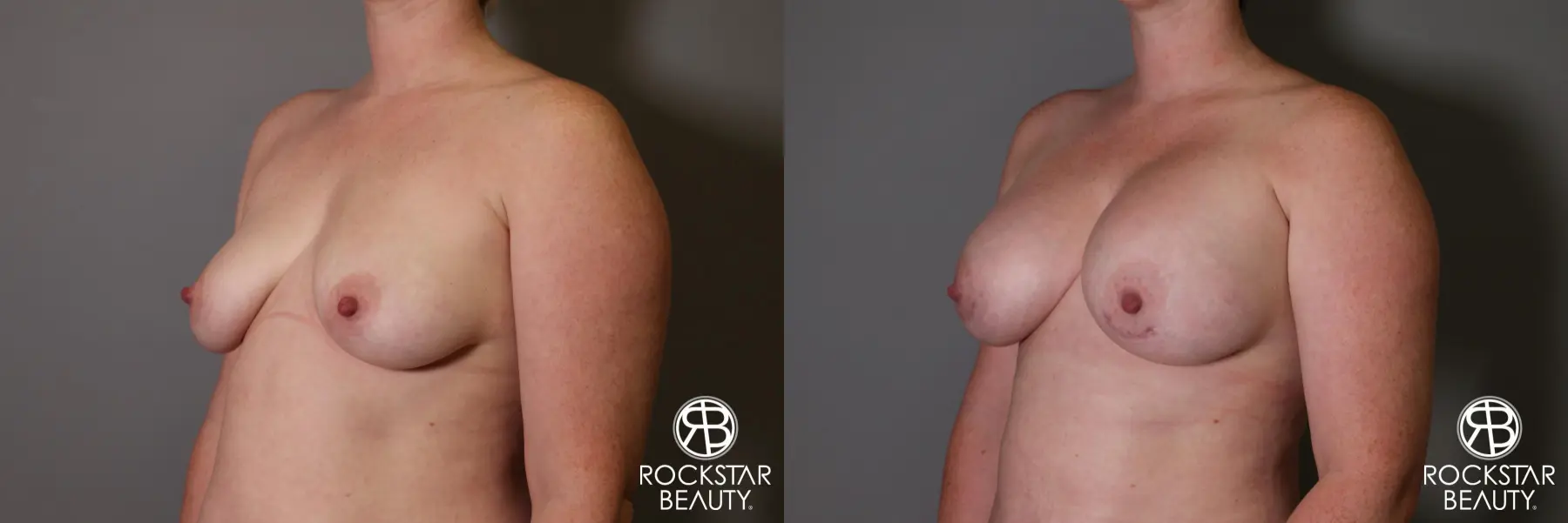 Breast Augmentation: Patient 11 - Before and After 4
