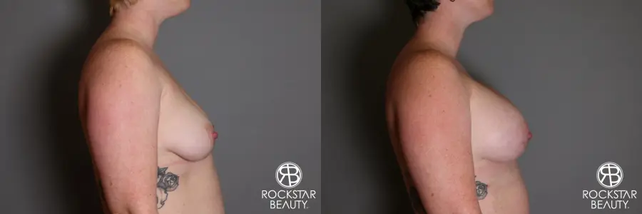 Breast Augmentation: Patient 11 - Before and After 3