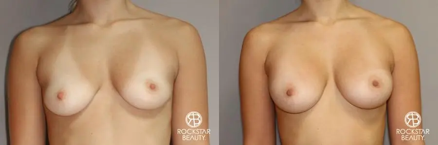 Breast Augmentation: Patient 7 - Before and After 1