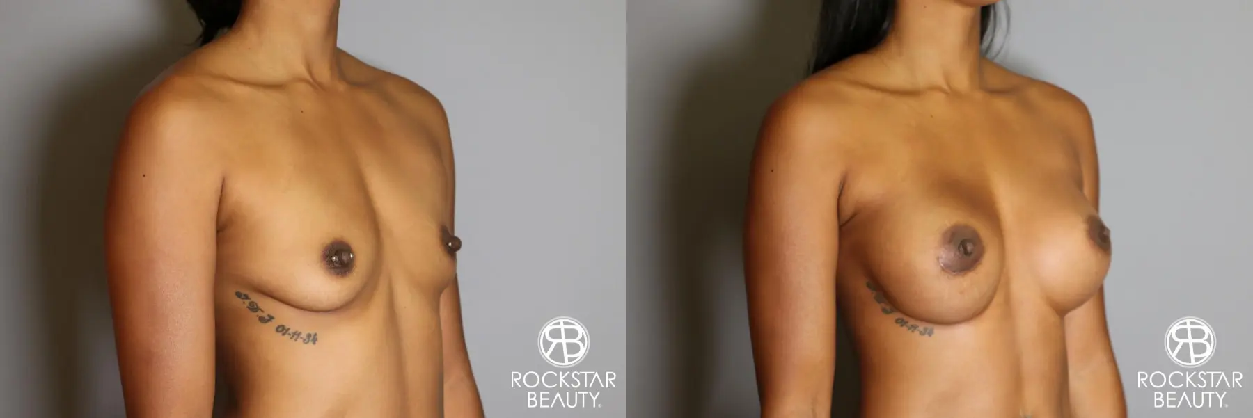 Breast Augmentation: Patient 14 - Before and After 2