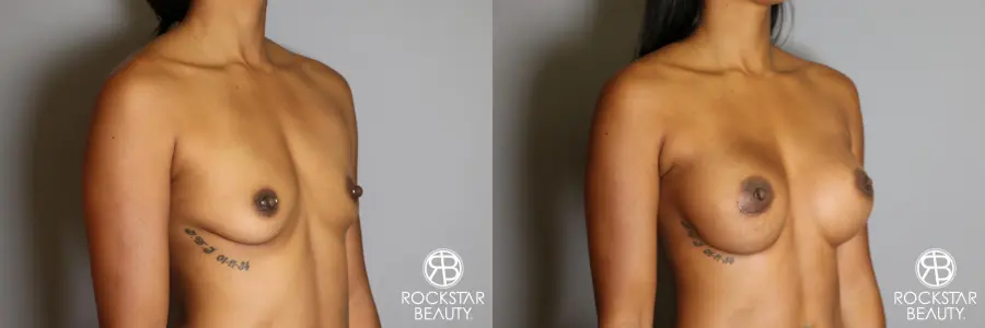 Breast Augmentation: Patient 14 - Before and After 2