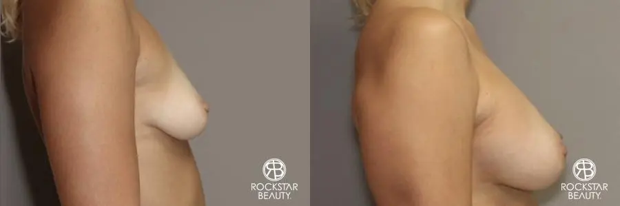 Breast Augmentation: Patient 7 - Before and After 3