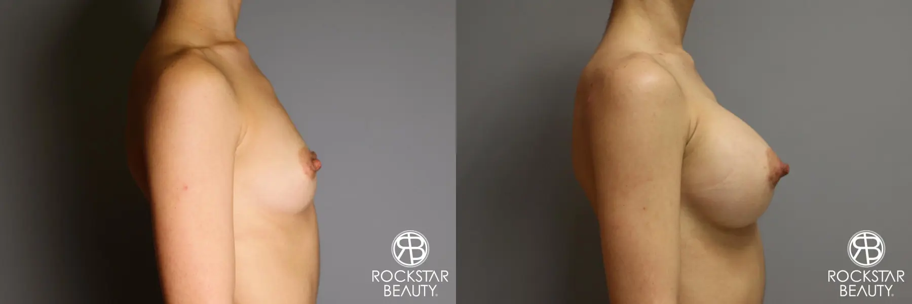 Breast Augmentation: Patient 17 - Before and After 5