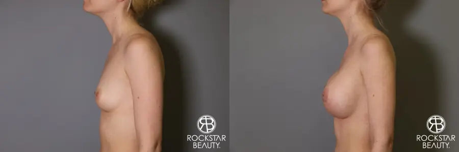 Breast Augmentation: Patient 2 - Before and After 5