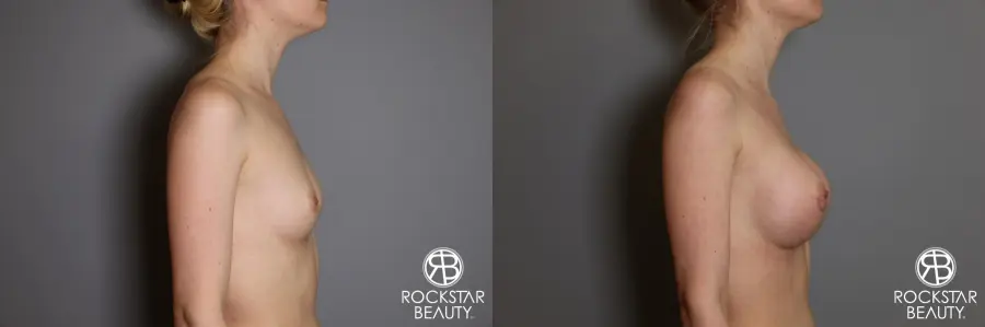 Breast Augmentation: Patient 2 - Before and After 3