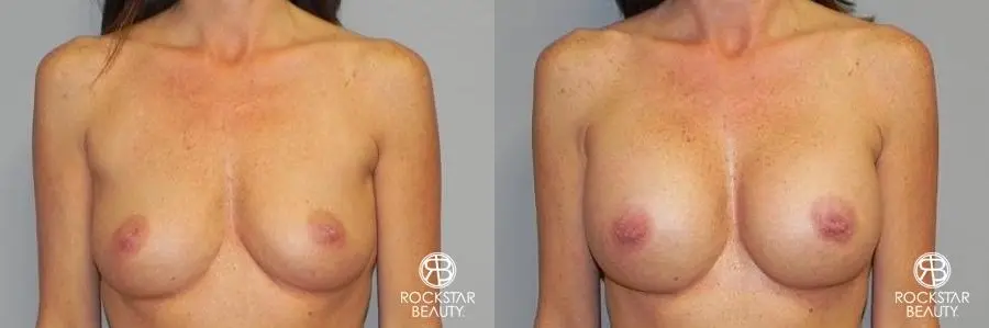 Breast Augmentation: Patient 5 - Before and After 1