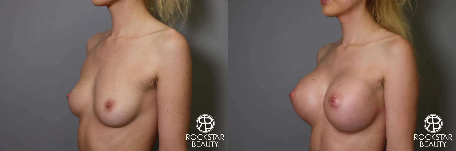 Breast Augmentation: Patient 1 - Before and After 4