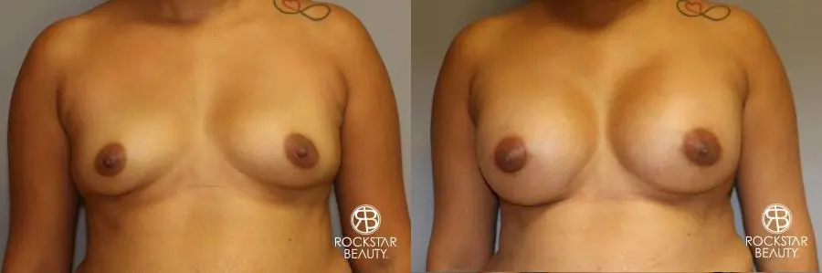 Breast Augmentation: Patient 9 - Before and After  