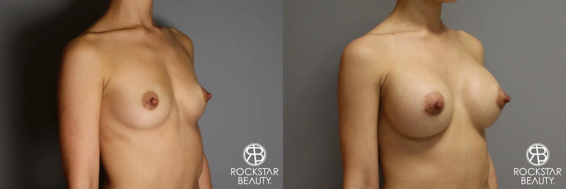 Breast Augmentation: Patient 17 - Before and After 4