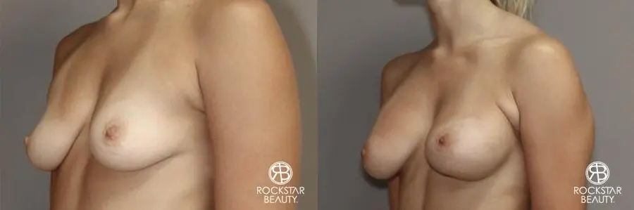 Breast Augmentation: Patient 7 - Before and After 4