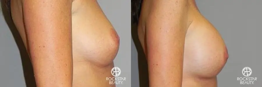 Breast Augmentation: Patient 5 - Before and After 3