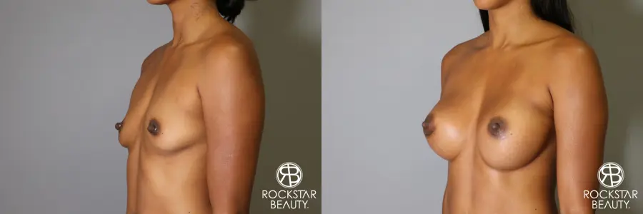 Breast Augmentation: Patient 14 - Before and After 3