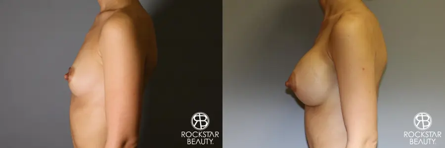 Breast Augmentation: Patient 17 - Before and After 3