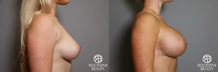 Breast Augmentation: Patient 15 - Before and After 3