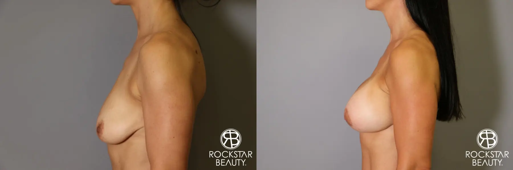 Breast Augmentation: Patient 12 - Before and After 5