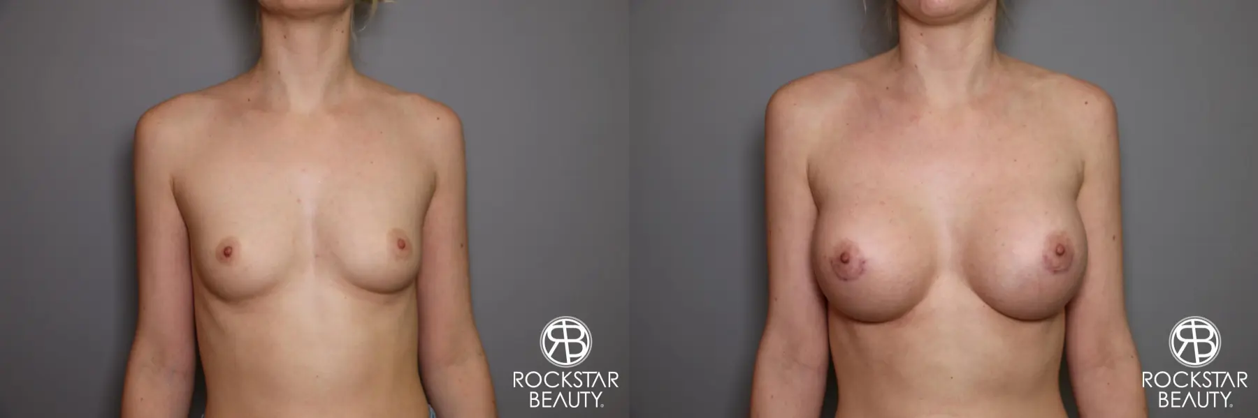 Breast Augmentation: Patient 2 - Before and After 1