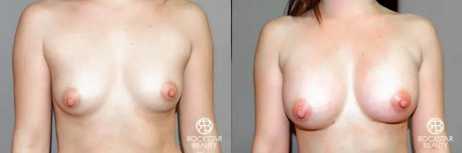 Breast Augmentation: Patient 6 - Before and After  