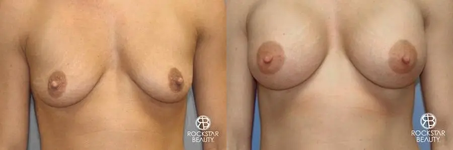 Breast Augmentation: Patient 8 - Before and After  