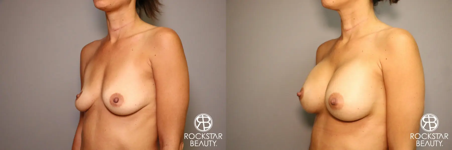 Breast Augmentation: Patient 3 - Before and After 5