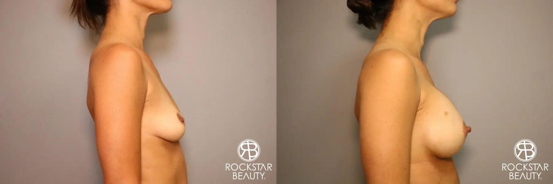 Breast Augmentation: Patient 3 - Before and After 3