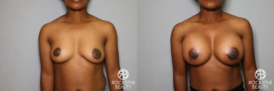 Breast Augmentation: Patient 10 - Before and After  