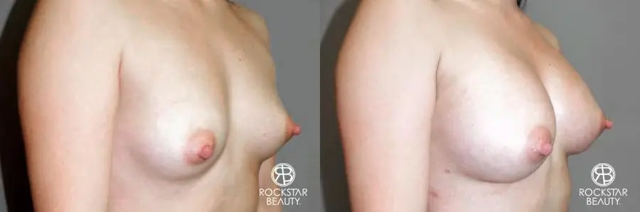 Breast Augmentation: Patient 6 - Before and After 2