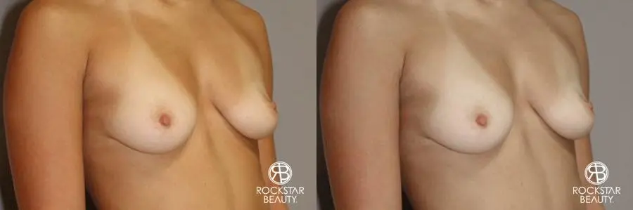 Breast Augmentation: Patient 7 - Before and After 2