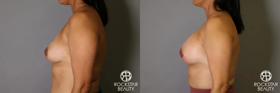 Breast Augmentation: Patient 13 - Before and After 5