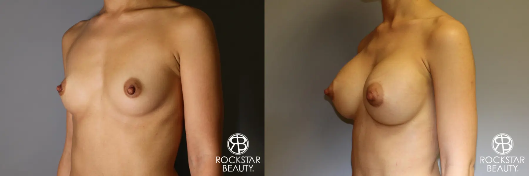 Breast Augmentation: Patient 17 - Before and After 2