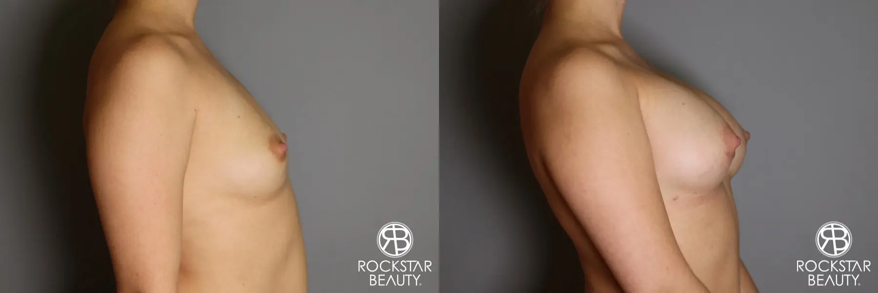 Breast Augmentation: Patient 16 - Before and After 5