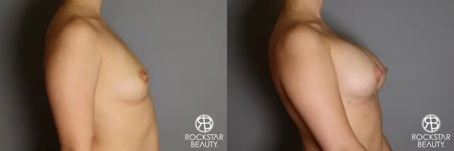 Breast Augmentation: Patient 16 - Before and After 5